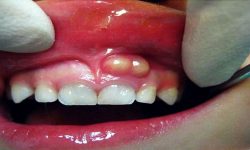 Áp xe răng là gì? Hình ảnh, cách phát hiện và điều trị hiệu quả