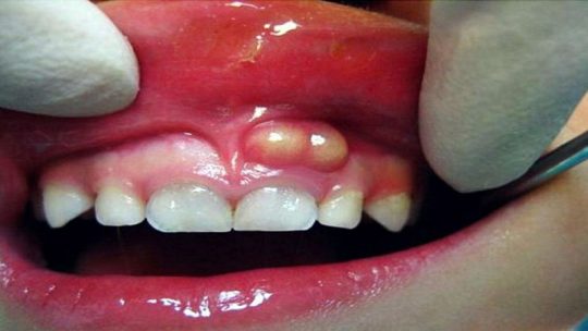 Áp xe răng là gì? Hình ảnh, cách phát hiện và điều trị hiệu quả
