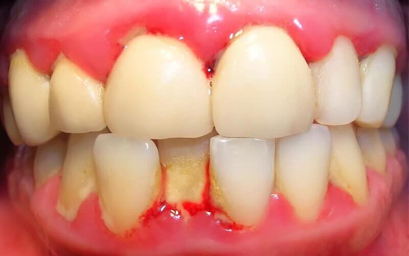Viêm nha chu là tình trạng viêm nhiễm tổ chứcxung quanh răng