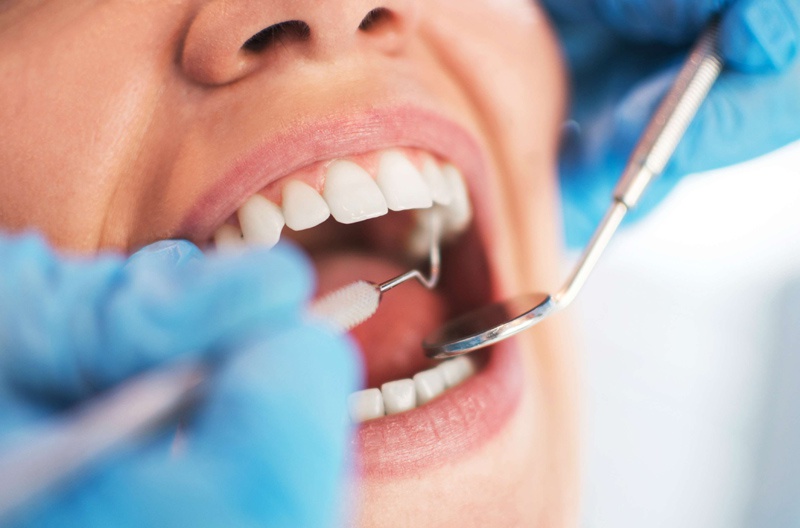Sâu răng ngà sâu cần được điều trị kịp thời