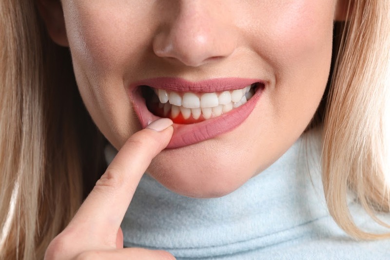 Ê buốt chân răng là bệnh gì? Viêm nha chu là bệnh lý điển hình