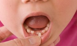 Nhổ răng sữa cho trẻ