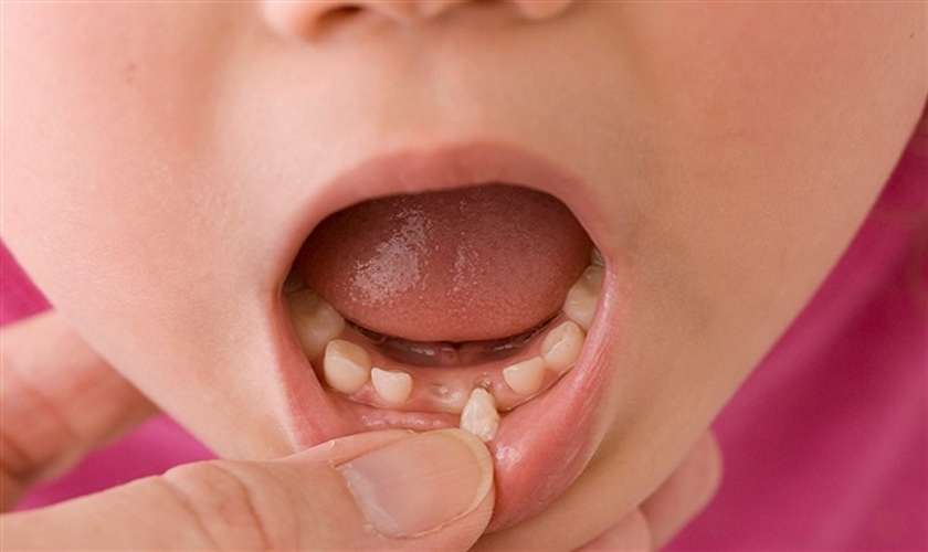 Nhổ răng sữa cho bé vào thời điểm thay răng