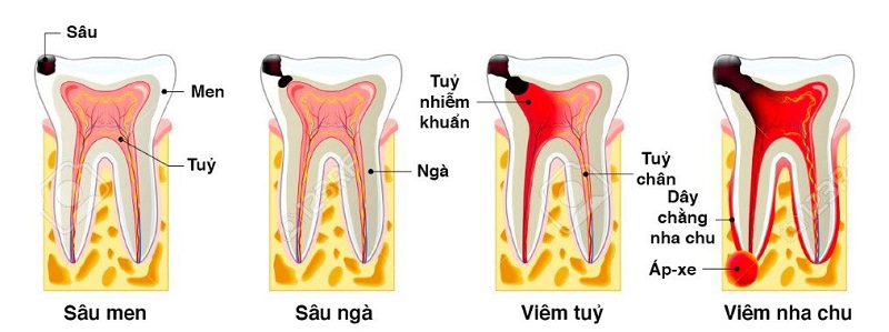 Quá trình sâu răng trải qua 4 giai đoạn