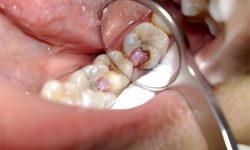 Răng sâu bị lồi thịt là gì? Làm sao để điều trị dứt điểm?