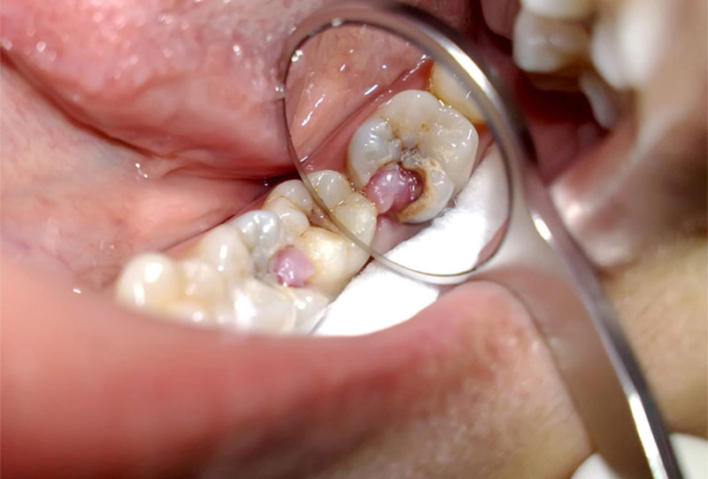 Răng sâu lồi thịt chảy máu đang ngày càng trở nên phổ biến