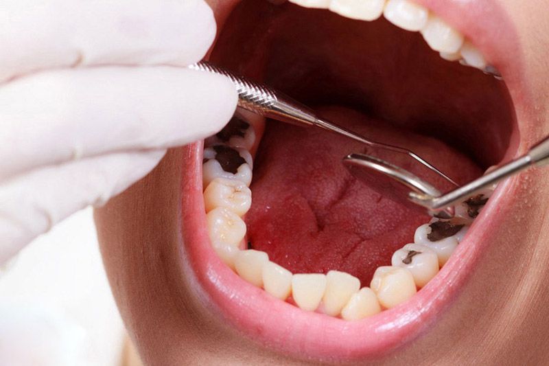 Sâu răng lồi thịt nếu không được chữa trị có thể gây mất răng vĩnh viễn