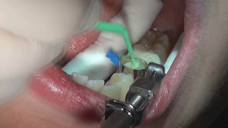 Trám răng điều trị răng sâu nhẹ hiệu quả