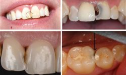 Bệnh sâu khe răng: Hình ảnh, chẩn đoán và cách điều trị khỏi