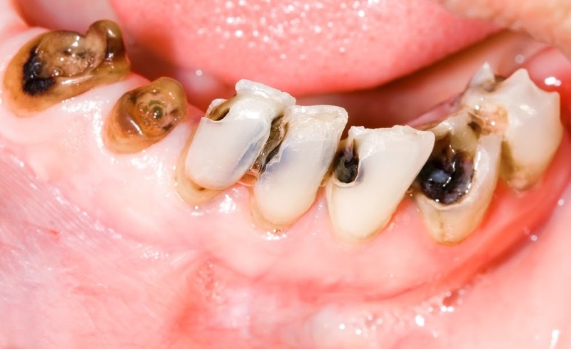 Sâu răng có thể nằm ở vị trí chân răng hoặc thân răng