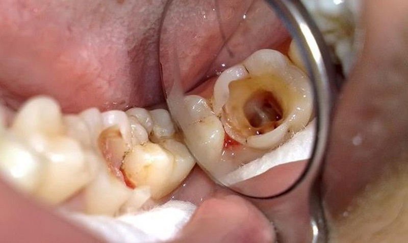 Vi khuẩn sâu răng xâm nhập, tấn công và phá hủy lớp men răng