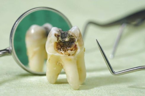 Sâu răng số 5