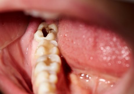 Sâu răng có chữa được không là câu hỏi mà nhiều người quan tâm