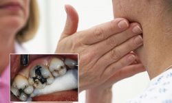 Sâu răng nổi hạch - Dấu hiệu nguy hiểm không thể xem thường