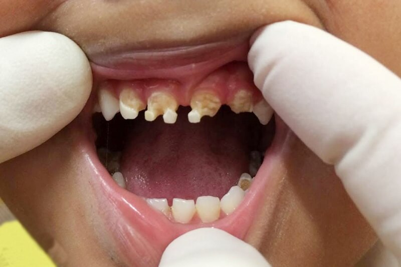 Sún răng trẻ em ảnh hưởng tới quá trình phát triển của răng vĩnh viễn