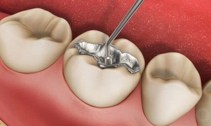Trám răng sâu bằng chất liệu gì? Composite, amalgam được sử dụng phổ biến
