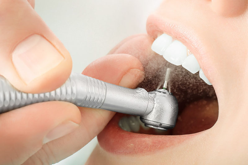 Đây là kỹ thuật cần thiết khi răng đã xuất hiện các tổn thương