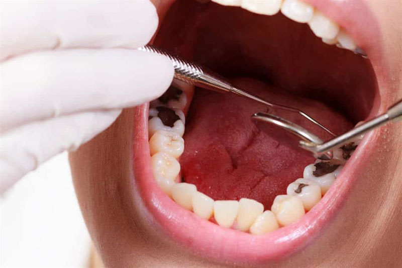 Kỹ thuật trám răng thường ít gây đau đớn