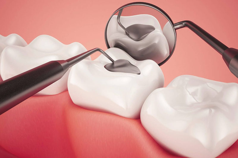 Miếng dán trám răng có thể tồn tại trong vòng 3-5 năm