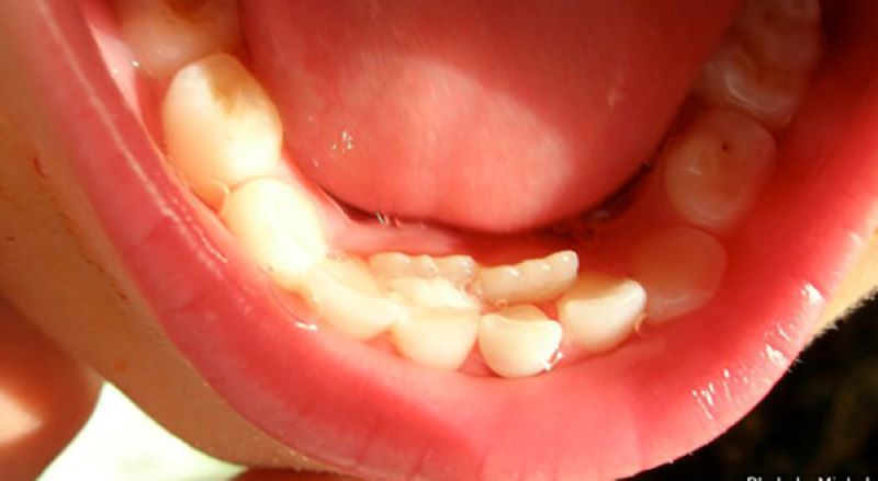 Trường hợp răng vĩnh viễn mọc cùng răng sữa sẽ gây ảnh hưởng đến thẩm mỹ của bé