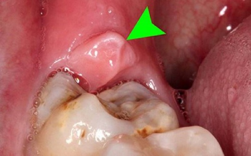 Áp xe răng là biến chứng thường gặp khi mọc răng số 8