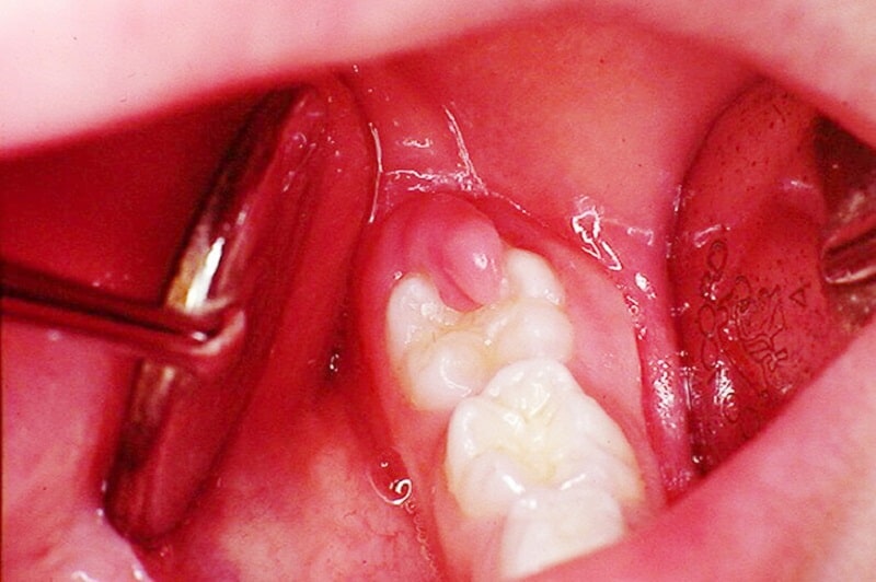 Phần nướu quanh chân răng bị sưng, ngả màu là dấu hiệu bệnh