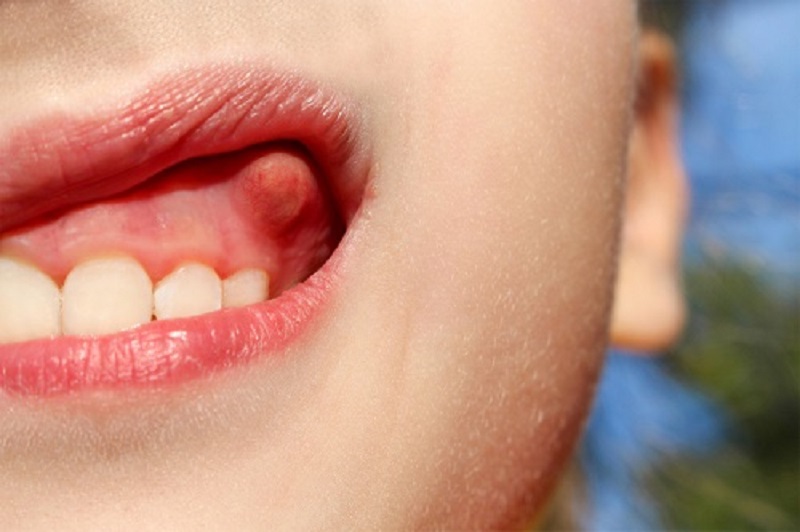 Áp xe răng ở trẻ em là bệnh lý về nhiễm trùng thường gặp