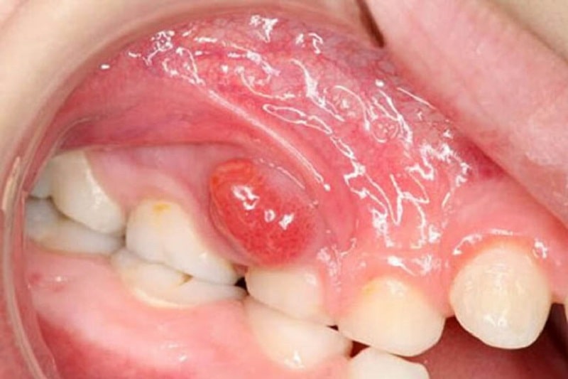 Áp xe răng nếu để lâu mà không điều trị có thể gây ra nhiều biến chứng nguy hiểm