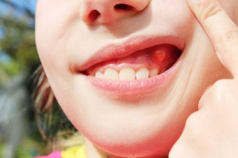 áp xe răng ở trẻ em