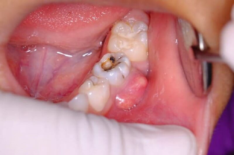Áp xe răng số 7 là trên răng số 7 hình thành bọc mủ bao quan lấy phần mô