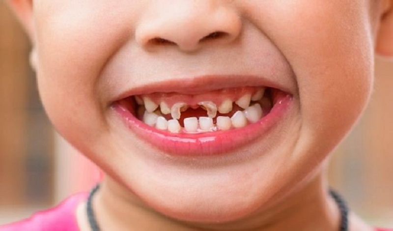 Sún răng là bệnh lý về răng miệng phổ biến ở trẻ nhỏ