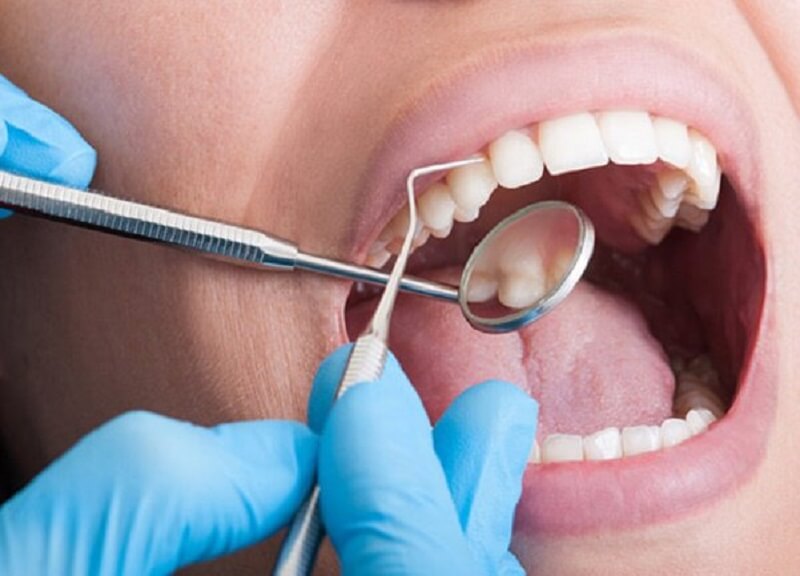 Người bị nền răng yếu dễ bị ê răng sau khi lấy vôi răng
