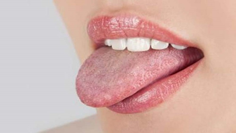 Nhiều người ăn thơm có hiện tượng bị tưa lưỡi