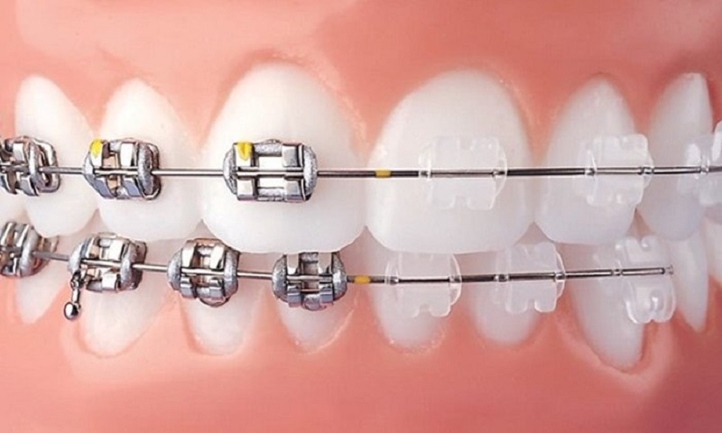 Dây cung niềng răng là dụng cụ không thể thiếu nếu bạn chỉnh nha bằng mắc cài