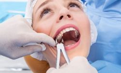 Nhổ răng được chỉ định với trường hợp bệnh nhân bị áp xe rặng
