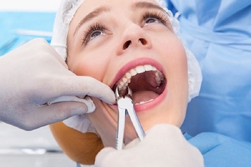 Nhổ răng được chỉ định với trường hợp bệnh nhân bị áp xe rặng