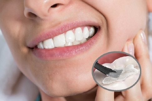 Các nguyên nhân chính gây ra hiện tượng bị ê răng sau khi trám