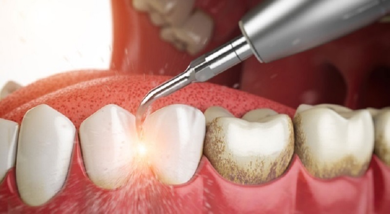 Sử dụng sóng laser, siêu âm hoặc dụng cụ để loại bỏ cao răng