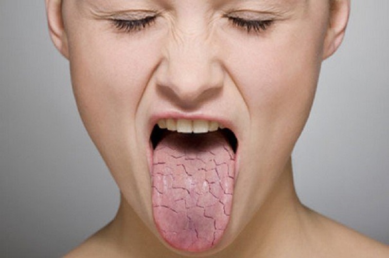 Khô miệng sẽ góp phần làm tăng khả năng bị hôi miệng