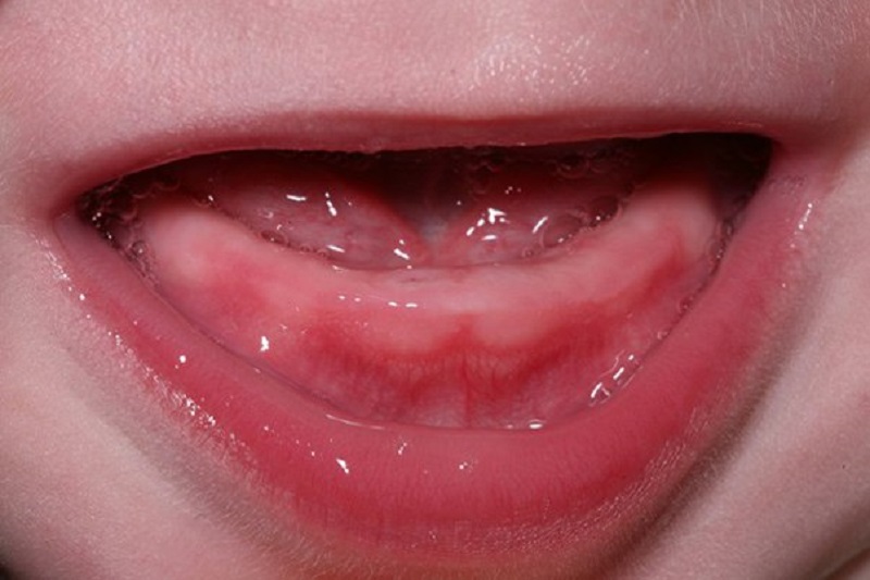 Trẻ chậm mọc răng thường do chế độ dinh dưỡng của bé chưa phù hợp