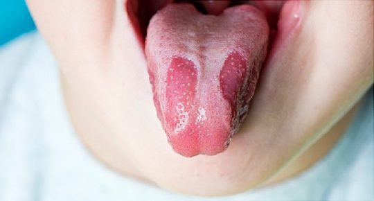 Nấm lưỡi bản đồ là bệnh lành tính