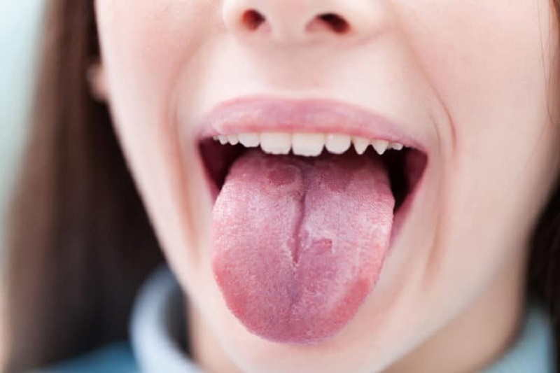 Nấm miệng còn được gọi là bệnh tưa lưỡi
