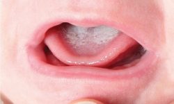 Nấm miệng trẻ em còn có tên khác là tưa lưỡi hoặc đẹn trăng