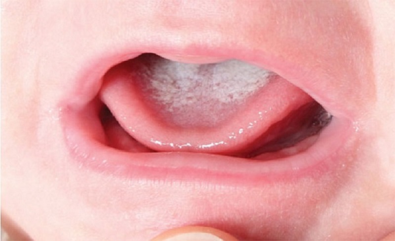 Nấm miệng trẻ em còn có tên khác là tưa lưỡi hoặc đẹn trăng