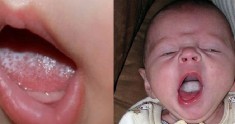 Bệnh nấm miệng ở trẻ cần được điều trị kịp thời