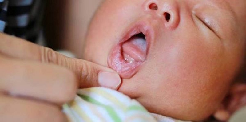 Bệnh nấm miệng trẻ sơ sinh có thể lây lan qua nhiều con đường