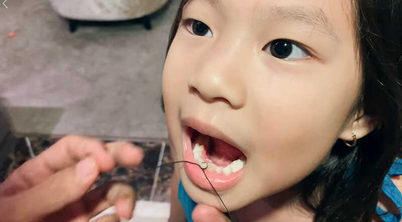 Nhổ răng bằng chỉ là phương pháp đánh lạc hướng, giảm đau khi nhổ cho trẻ hiệu quả nhất