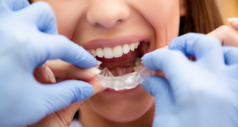 Quá trình niềng răng Invisalign ở người lớn mất khoảng 12 đến 18 tháng