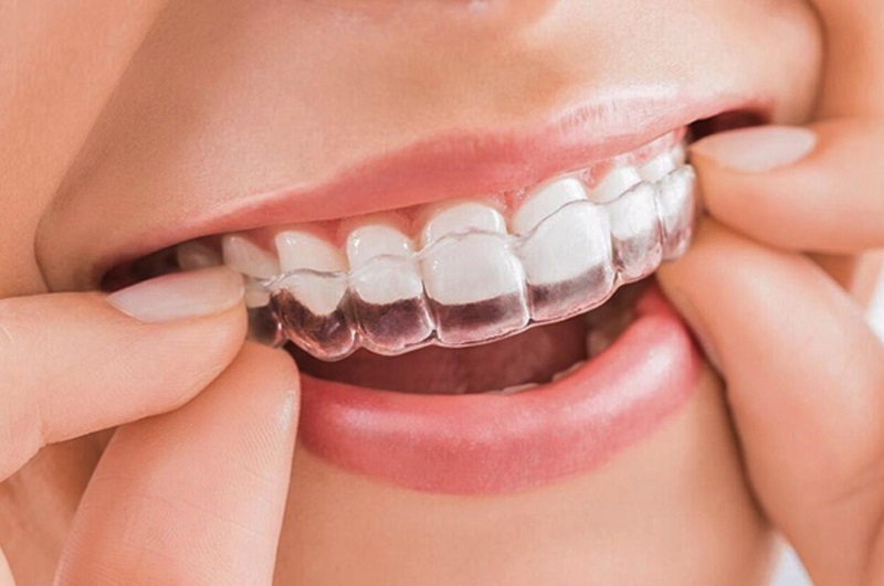Niềng răng giúp bạn có một hàm răng trắng sáng và đẹp hơn