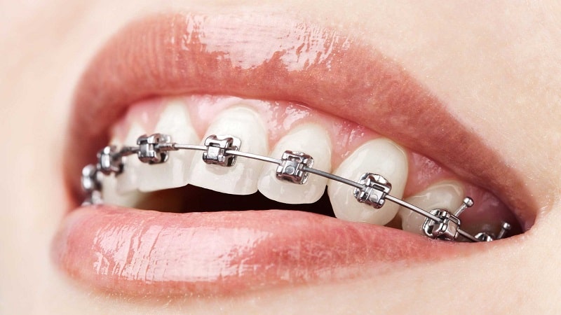 Hình thức niềng răng sử dụng mắc cài làm bằng chất liệu kim loại